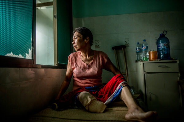Phu Thi Hong Thuy, 48, in the recovery area of Nguyen Tri Phung Hospital in HCMC, Vietnam from her recent amputation surgery as a result of diabetes. Thuy is from the Mekong Delta region in Ca Mao Province, she was diagnosed with diabetes 1 year ago.